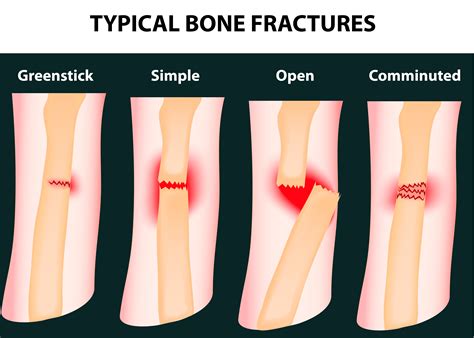 Significance of Dreams Depicting a Companion's Leg Fracture: Analysis and Implications