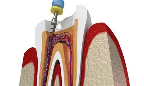 Solutions to Addressing Dreams of Decayed Teeth