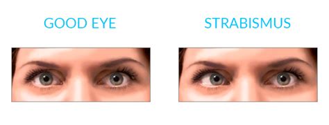 Strabismus: A Probable Cause of Asymmetrical Eye Appearance