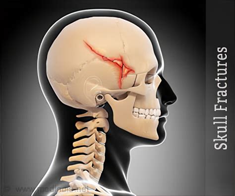 Symbolic Significance of a Fractured Cranium