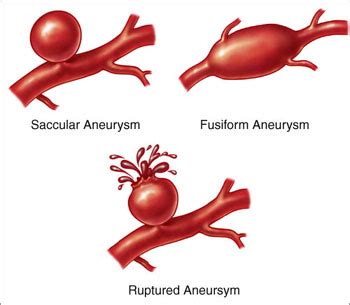 Symbolism and Imagery in Dreams Involving Brain Aneurysms