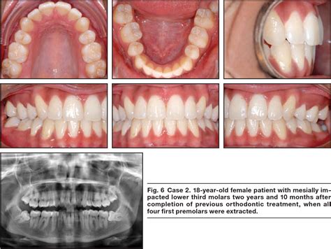 Symptoms and signs of problematic third molars