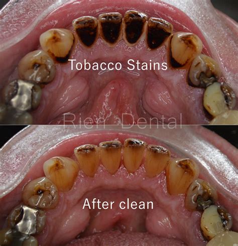 Tackling Tobacco Stains: Smoking and Discoloration of Teeth