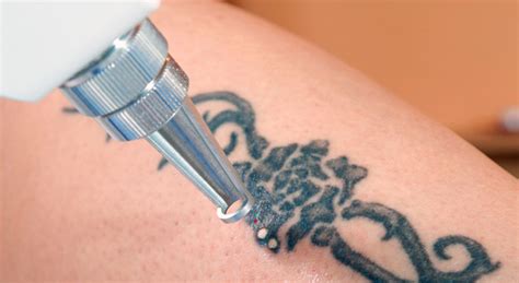 Tattoo Removal: Exploring Options for Undoing Your Ink