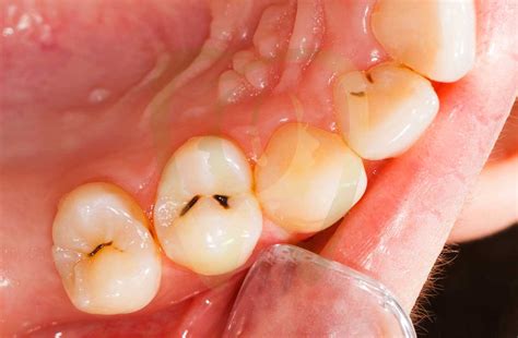 Teeth Rotting from the Inside: Hidden Stress or Anxiety