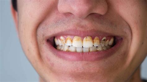 Teeth-Scraping Dreams and their Connection to Communication Challenges