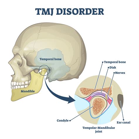 Temporomandibular Joint Disorder (TMJ): A Leading Cause of Jaw Immobilization