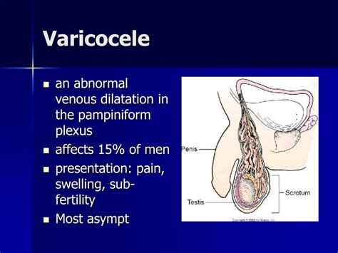 Testicular Discomfort and Its Link to Varicoceles