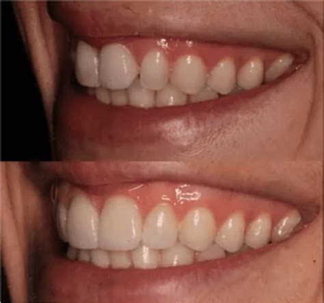 The Aesthetic Possibilities: Enhancing Your Smile with Translucent Enamel