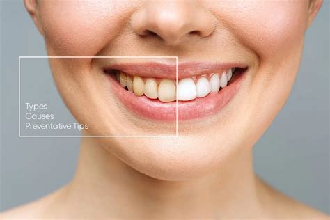 The Age Factor: Reasons Behind the Natural Discoloration of Teeth