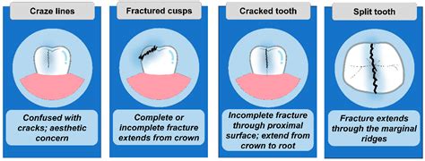 The Common Triggers Behind Experiencing Fractured Enamel in Dreams