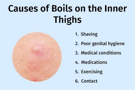 The Culprits Behind Boils: Causes and Risk Factors