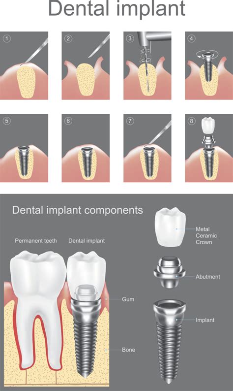 The Dental Implant Procedure: A Step-by-Step Breakdown