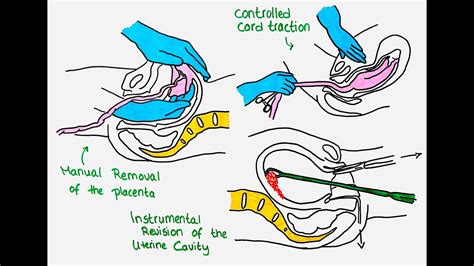 The Emotional Journey of Contemplating Uterine Removal