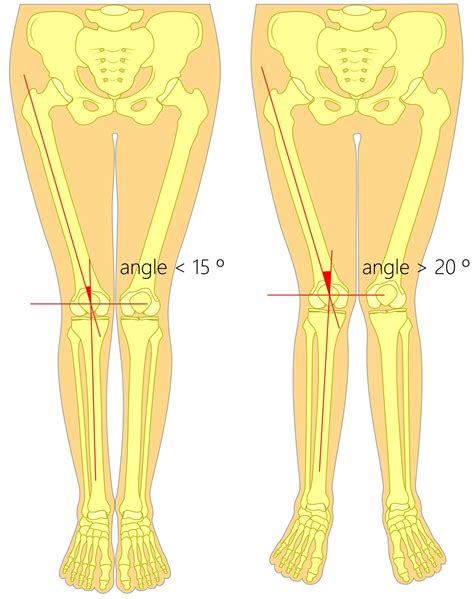 The Emotional Significance of Dreams Involving Unequal Leg Length