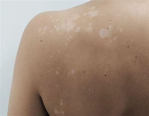 The Enigma Behind Pale Spots on the Epidermis