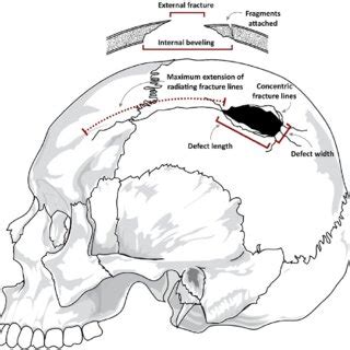 The Enigma of Dreaming after Cranial Trauma