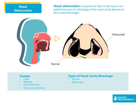 The Enigma of Nasal Obstruction