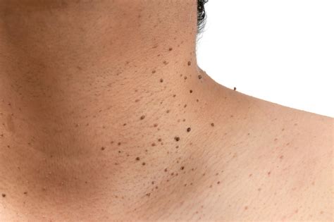 The Enigma of Skin Tags