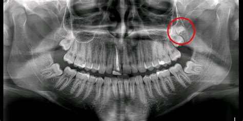 The Enigma of Supernumerary Teeth: Decoding the Science Behind Extra Dental Structures