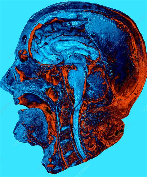 The Enigmatic Phenomenon of Dreaming Absent a Cranial Cavity