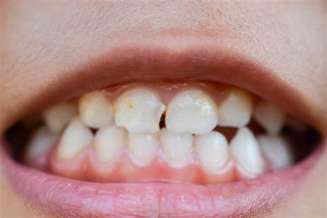 The Enigmatic Phenomenon of Misaligned Teeth in Dreams