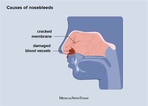 The Enigmatic Phenomenon of Nasal Haemorrhage in Dreams