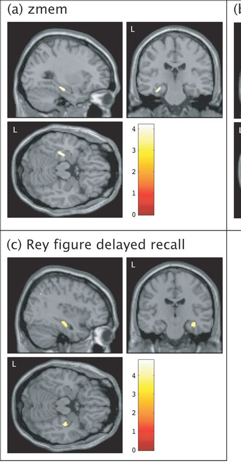 The Enigmatic Phenomenon of Recurring Memory Deficiency