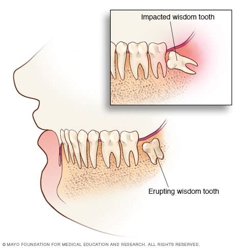 The Enigmatic Significance of Fantasizing about Extracting Wisdom Teeth
