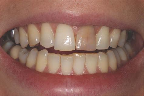 The Factors Behind Discolored Teeth: Triggers, Interpretations, and Remedies