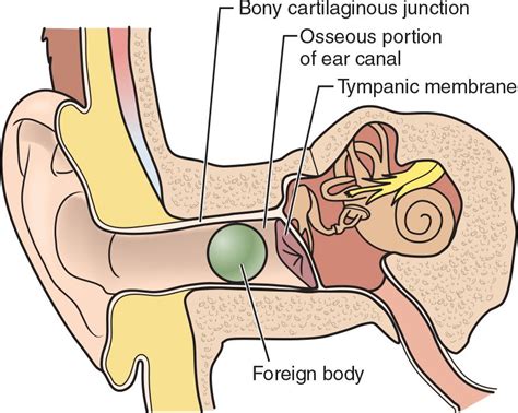 The Fascinating Phenomenon of Dreaming about Objects Lodged Inside the Auditory Canal