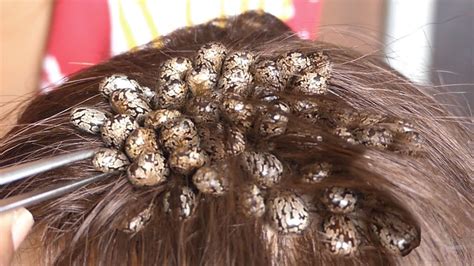 The Fascinating Phenomenon of Tick-Infested Hair Dreams