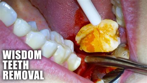 The Fascinating Universe of Tooth Extrication Fantasies