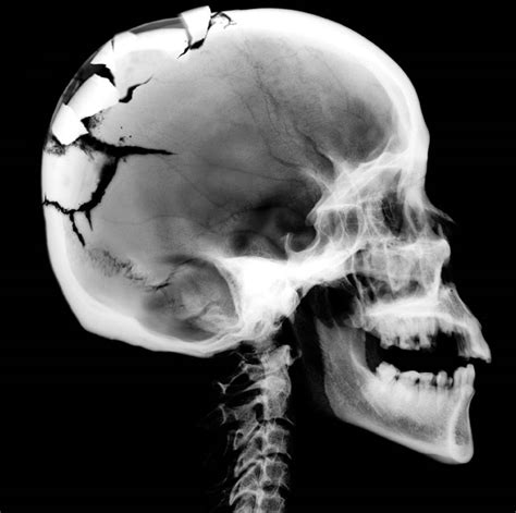 The Fascination of Dreams Involving the Concept of Cracking the Skull: A Comprehensive Examination