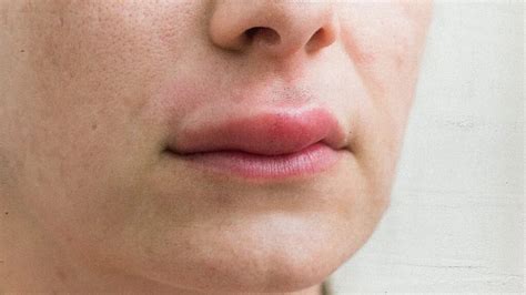 The Impact of Allergies: Identifying the Culprit Behind Swollen Lips