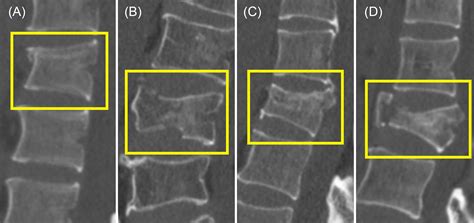 The Impact of Fractured Vertebrae Imageries on Psychological Well-being