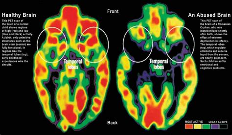 The Impact of Neglect on the Psyche: An Exploration of its Influence on Dreams