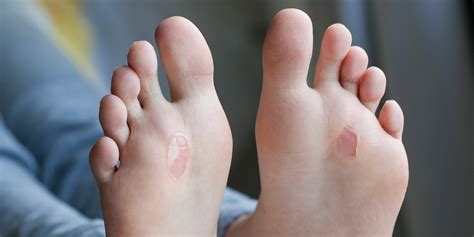 The Impact of Personal Experiences on Dreaming about Foot Blisters