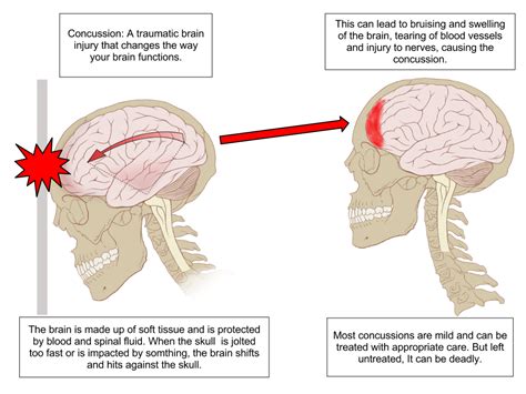 The Impact of Trauma on Dreams Involving Separation of the Head