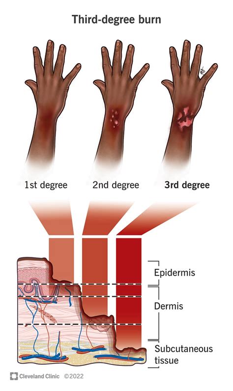 The Importance of Dreams in the Lives of Those Affected by Severe Burns