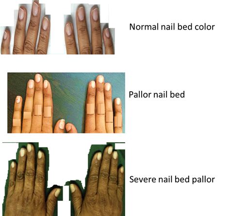 The Importance of Pale Marks on the Physical Form