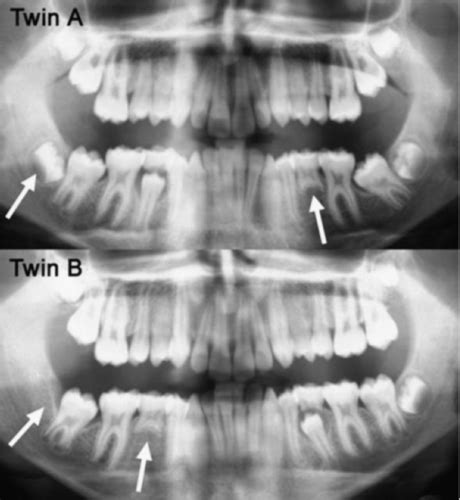 The Influence of Genetics on the Development of Dual Dentition