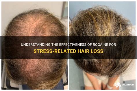 The Influence of Stress on Hair Growth