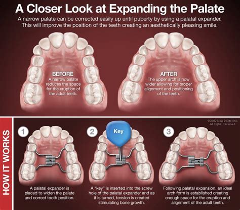 The Journey Begins: Installing Orthodontic Appliances