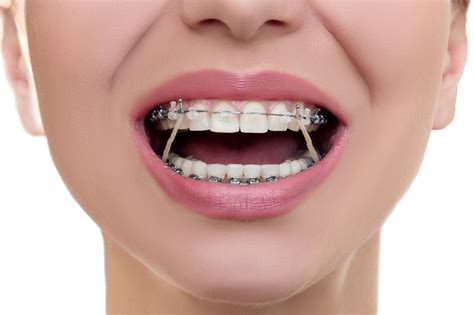 The Key to Success: Ensuring Proper Oral Care while Wearing Orthodontic Appliances