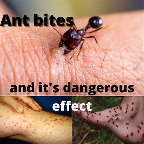 The Link Between Ant Bites and Feeling Anxious