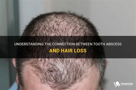 The Link between Hair and Teeth Loss Dreams and Anxiety