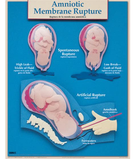 The Meaning Behind the Rupture of Amniotic Membranes during Pregnancy