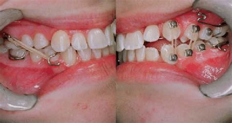 The Mysterious and Perplexing Phenomenon of Elastic Dentition