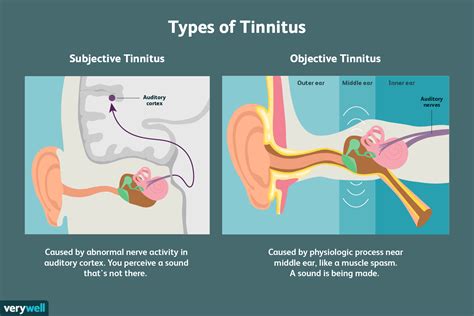 The Phenomenon of Tinnitus During Dreaming